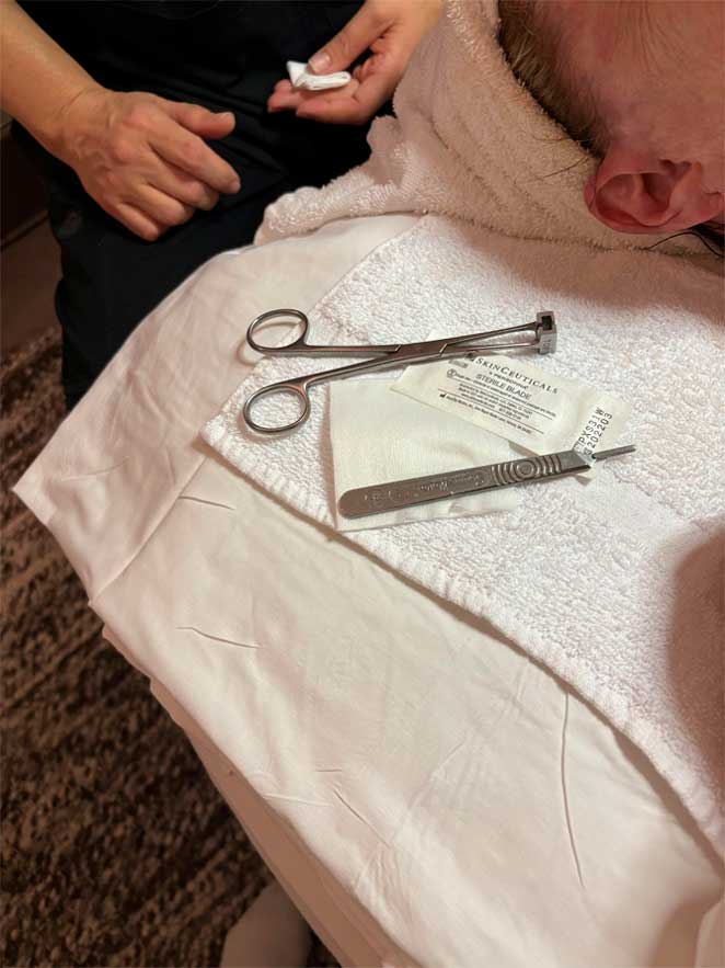 Dermaplaning treatment removing peach fuzz