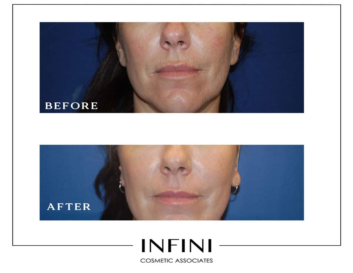 Laser Peel before and after results - Patient 4
