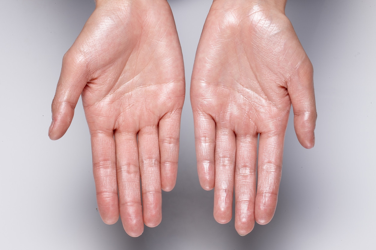 Excessive Sweating Treatment Process