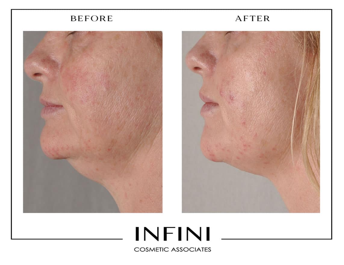 Morpheus8 before and after results, Scottsdale - Patient 1