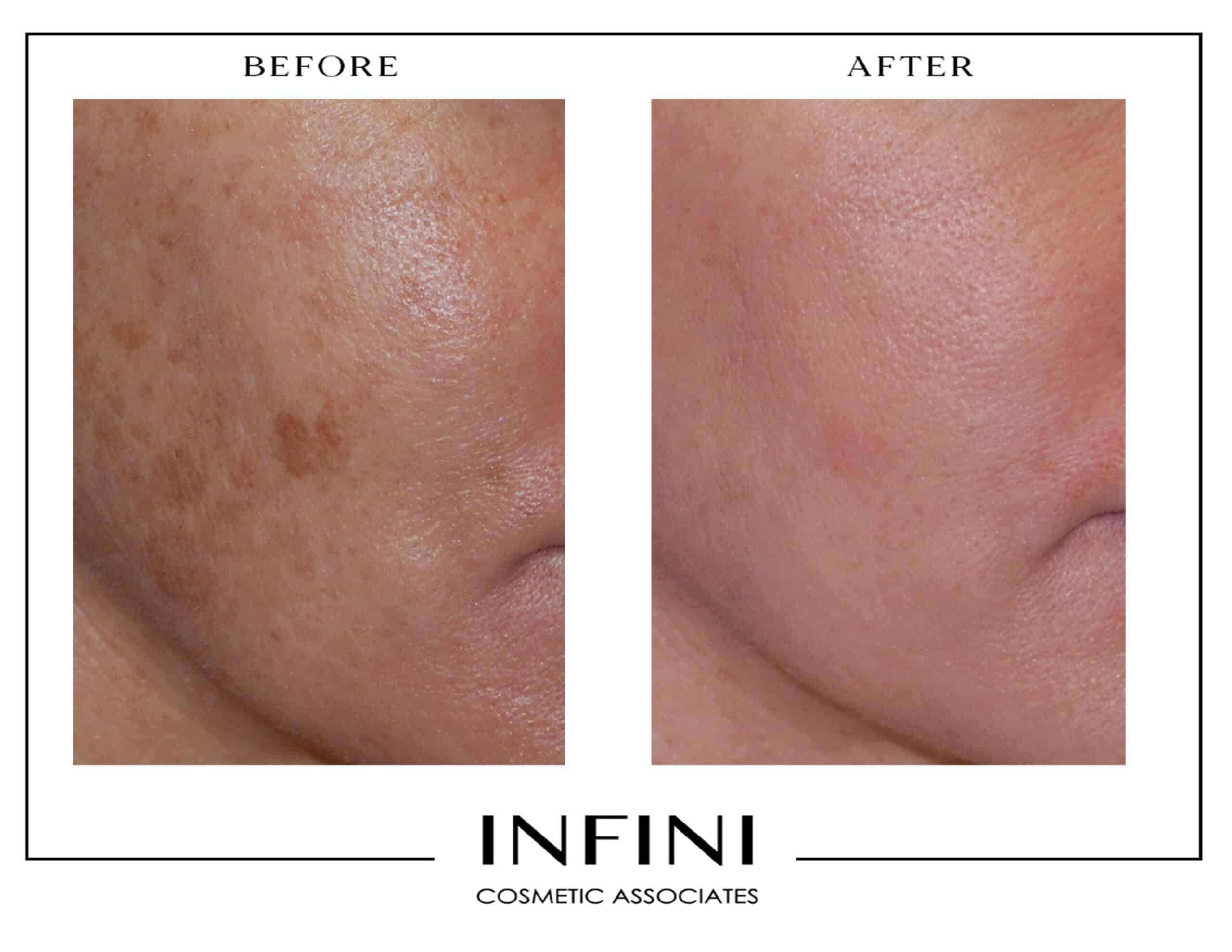 Before and after Fraxel treatment results - Patient 5
