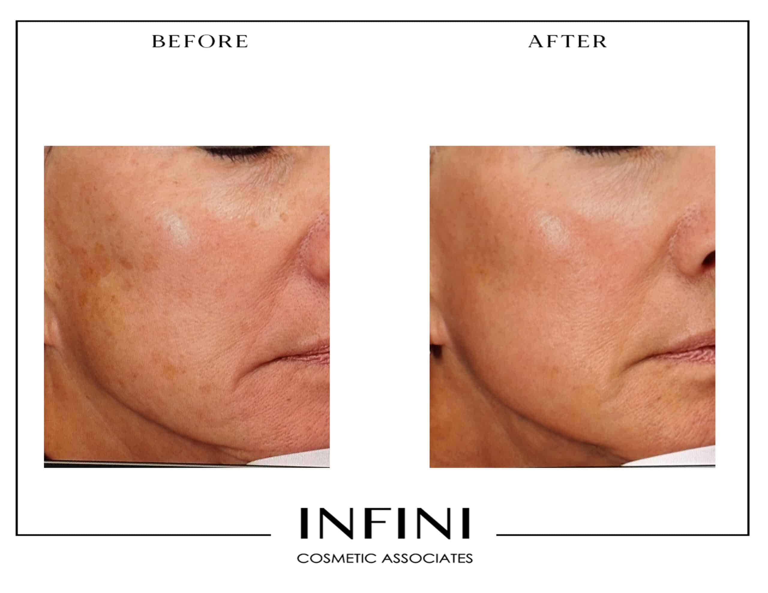 Before and after Fraxel treatment results - Patient 4