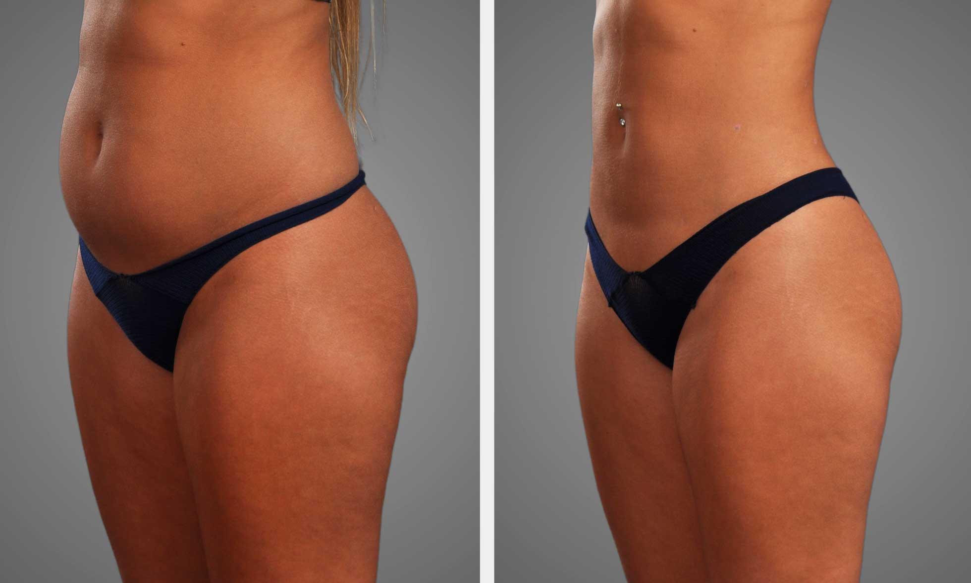 Gentle Sculpt Liposuction Procedure at Infini Cosmetic in Scottsdale