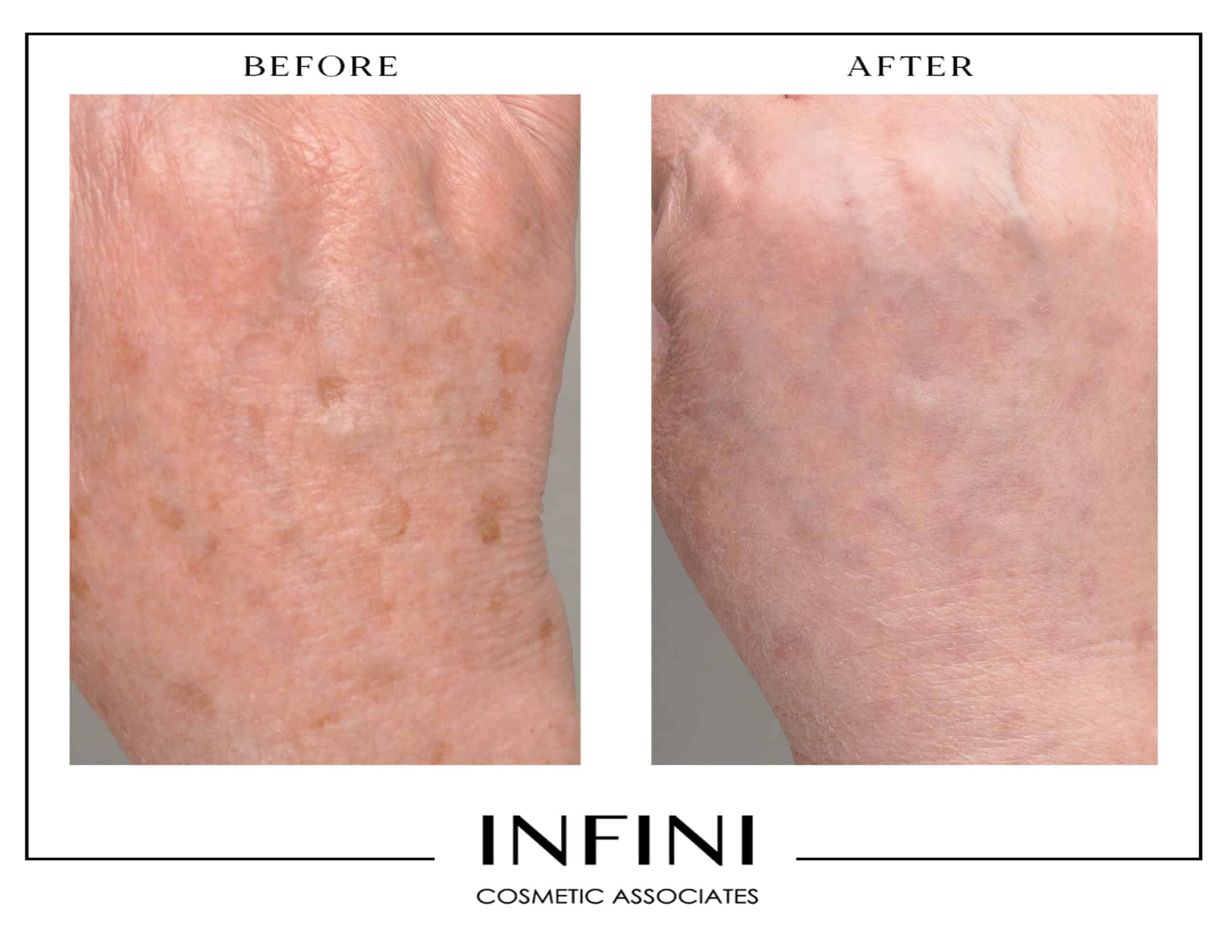 Before and after Fraxel treatment results - Patient 1