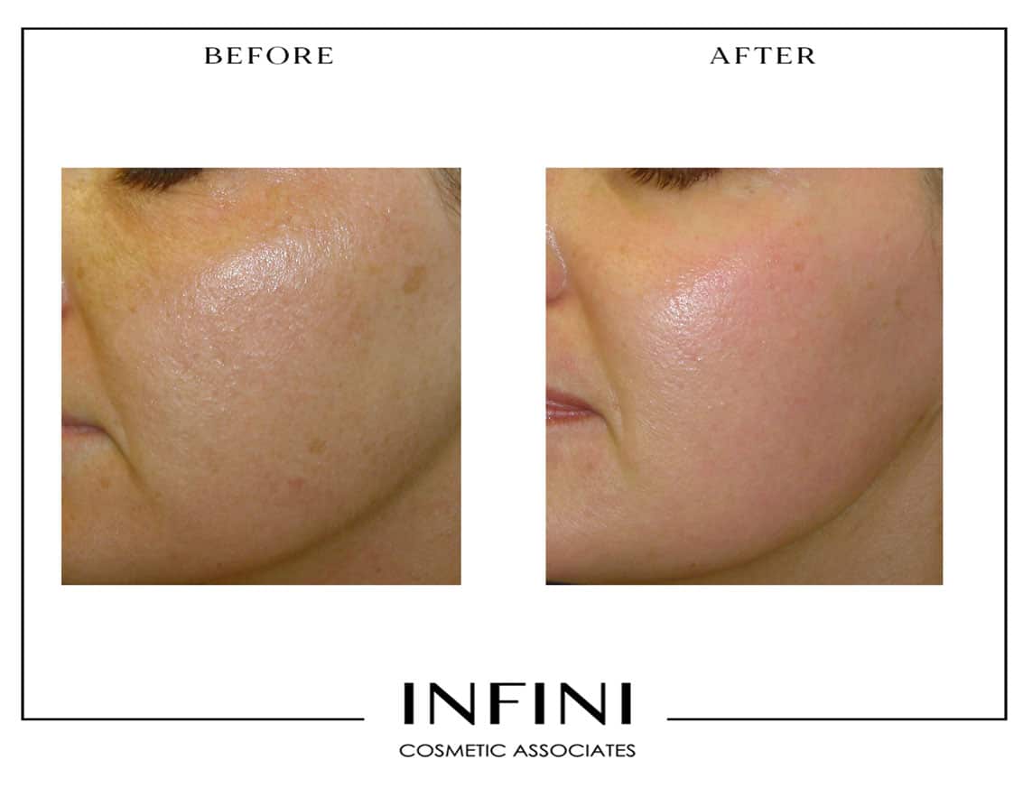 Laser Peel before and after results - Patient 3