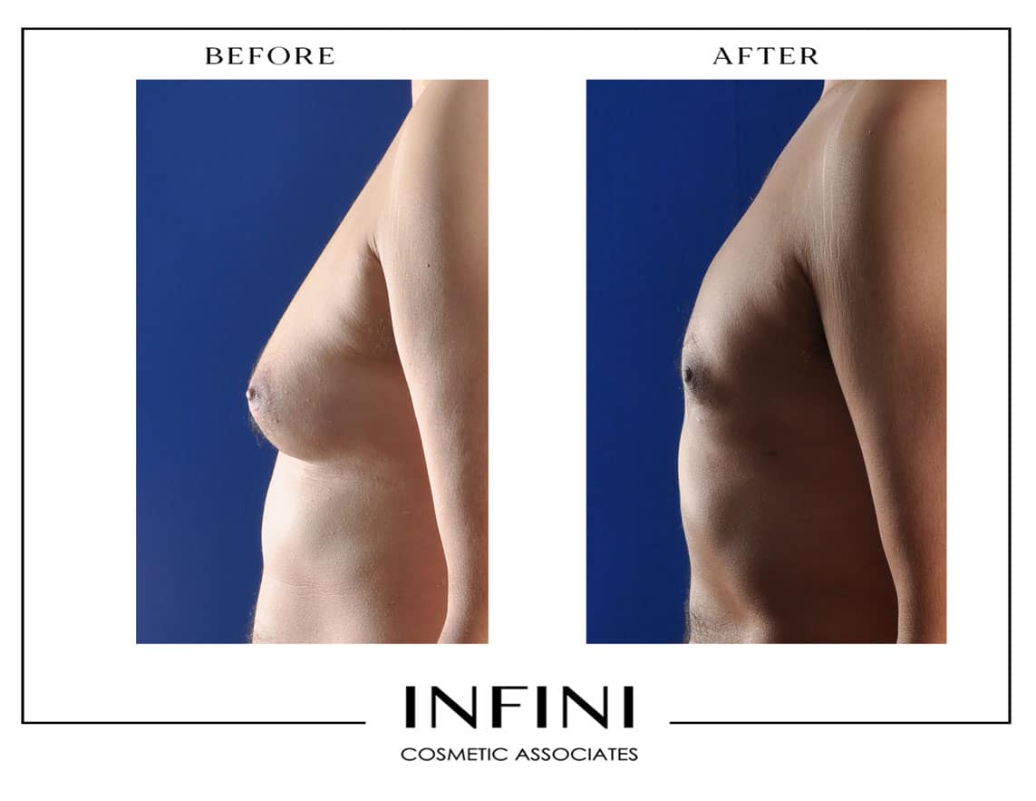 Gynecomastia before and after results - Patient 1