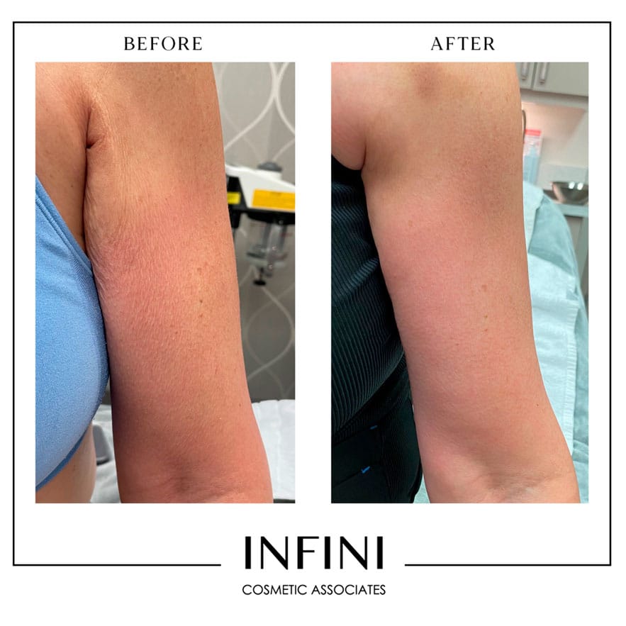 Morpheus8 before and after results on arms, Scottsdale - Patient 4