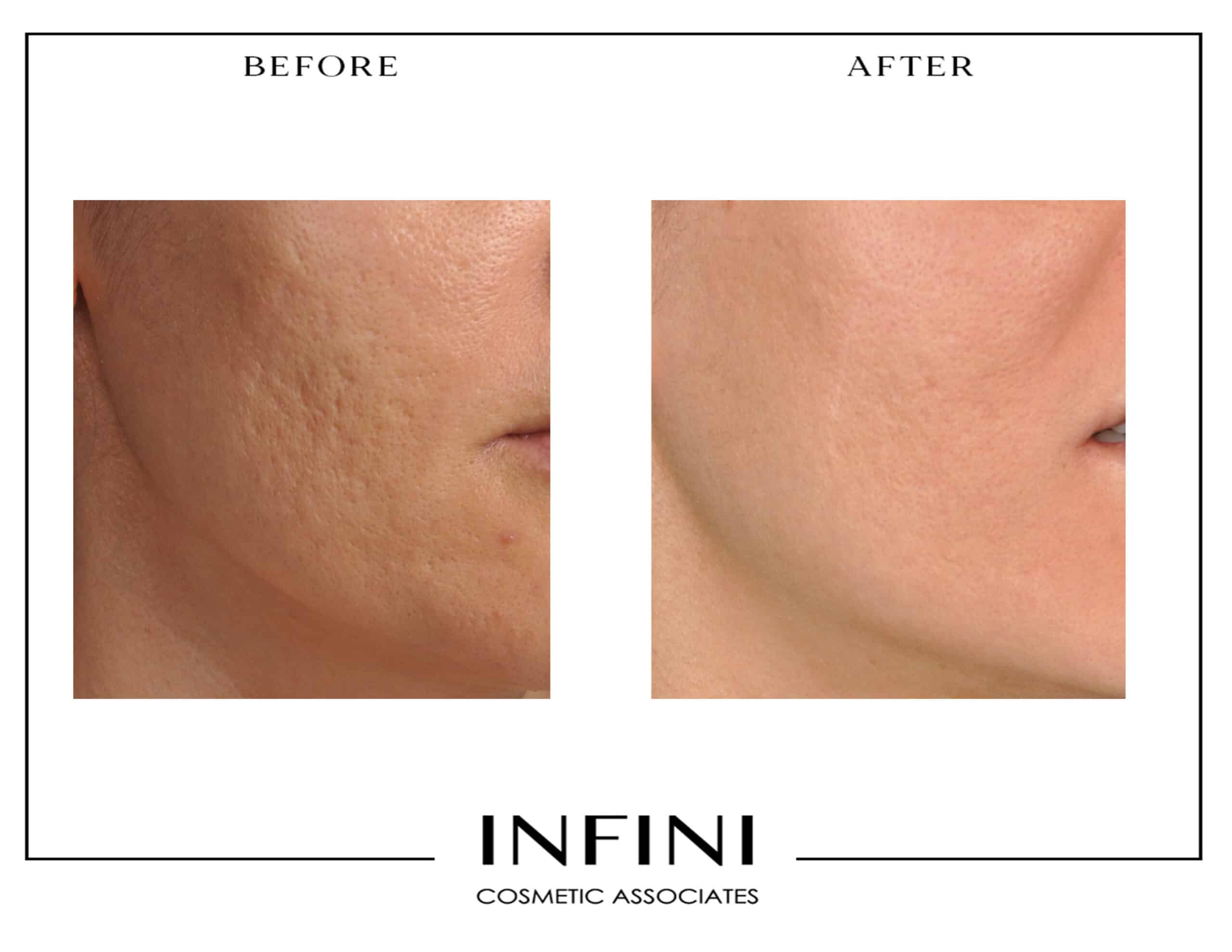 Before and after Fraxel treatment results - Patient 3