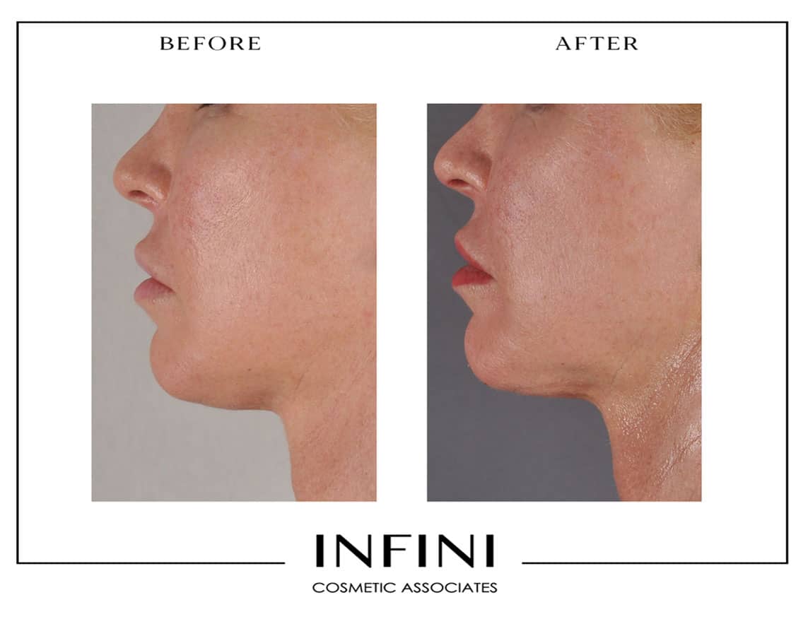 Morpheus8 before and after results, Scottsdale - Patient 3