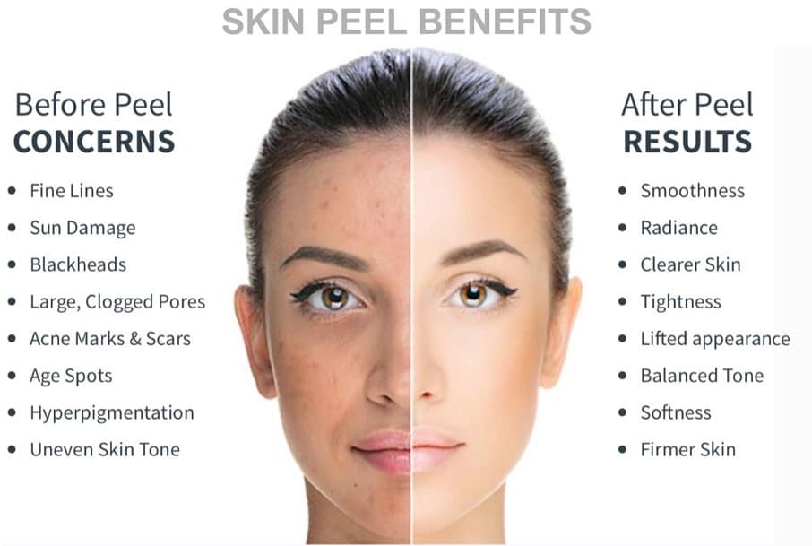 Benefits of chemical peels for skin texture, tone, and clarity