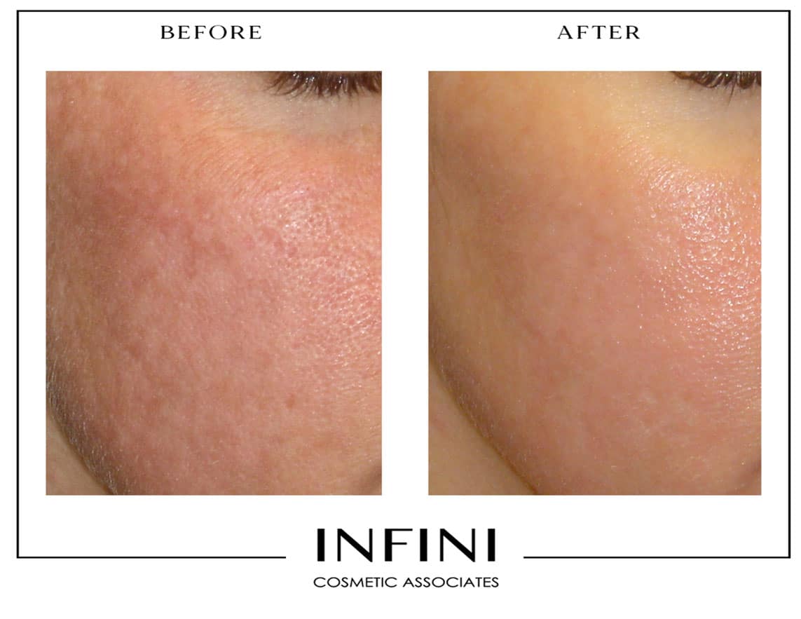Laser Peel before and after results - Patient 1