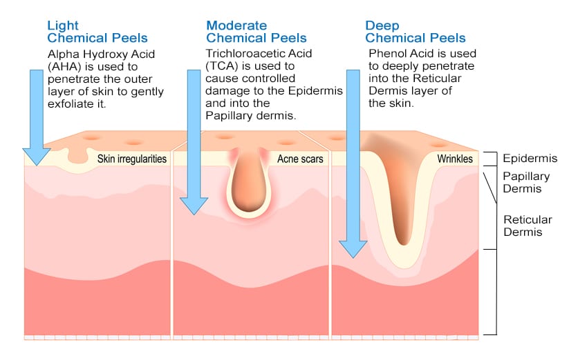 Diagram showing the penetrating depth of different chemical peels