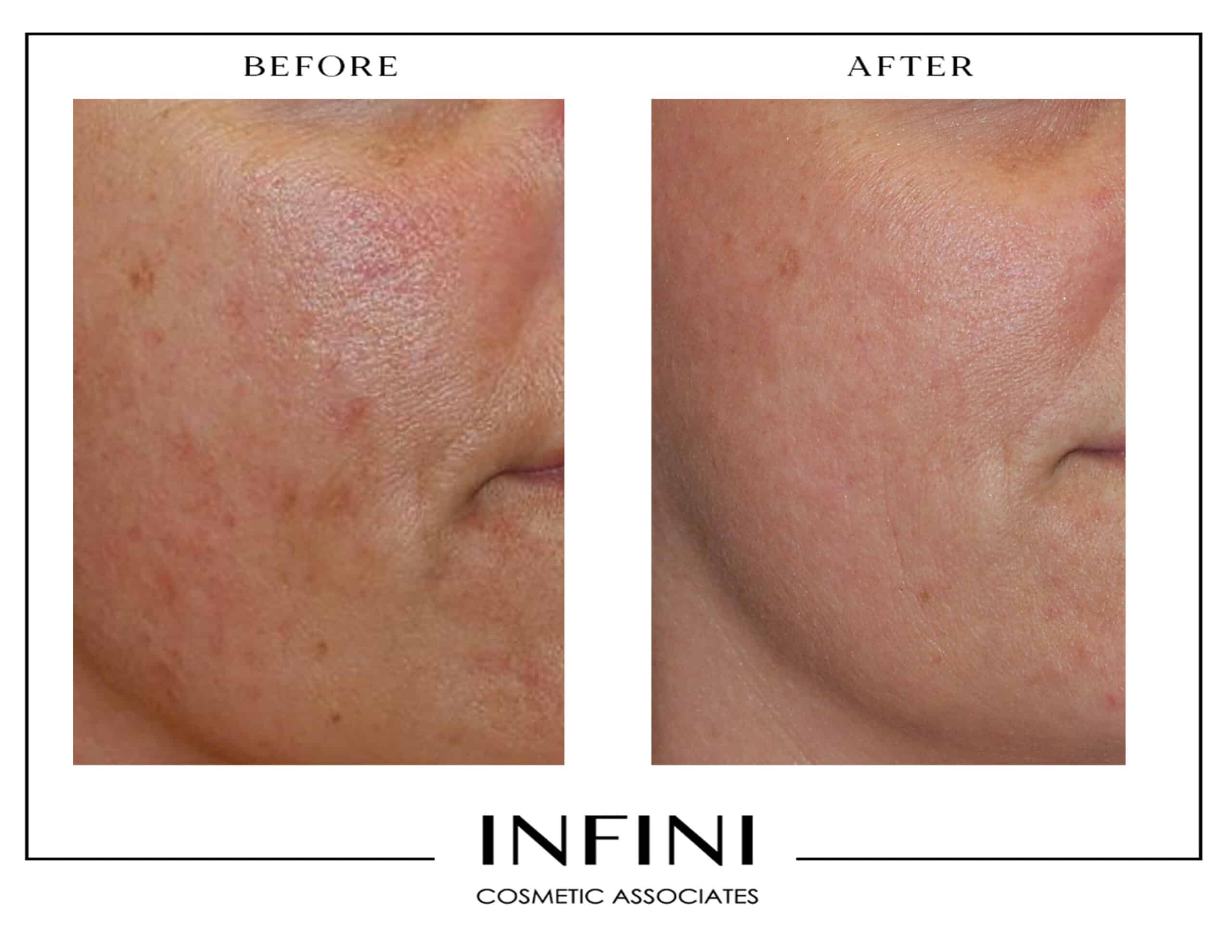 Before and after Fraxel treatment results - Patient 2