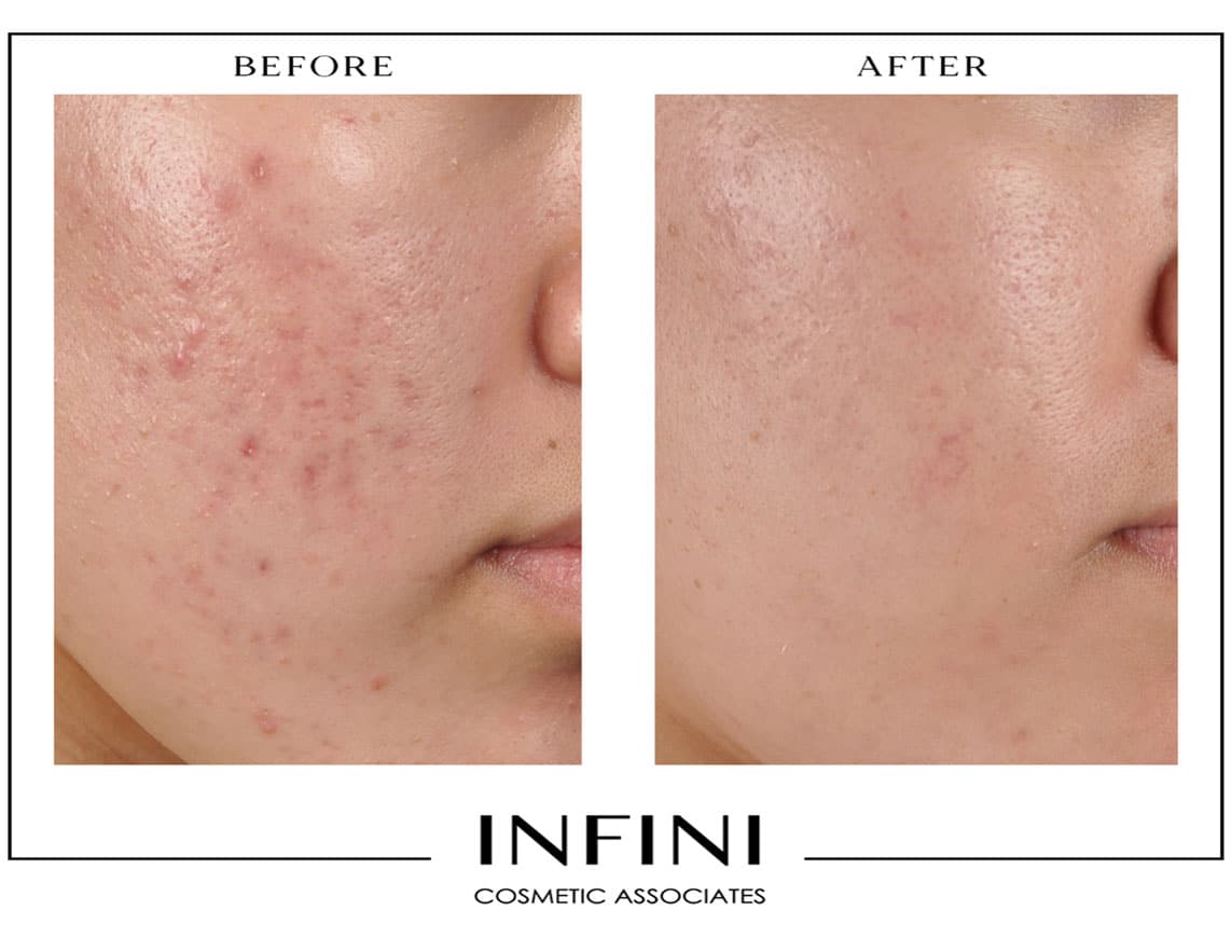 Morpheus8 before and after results, Scottsdale - Patient 2