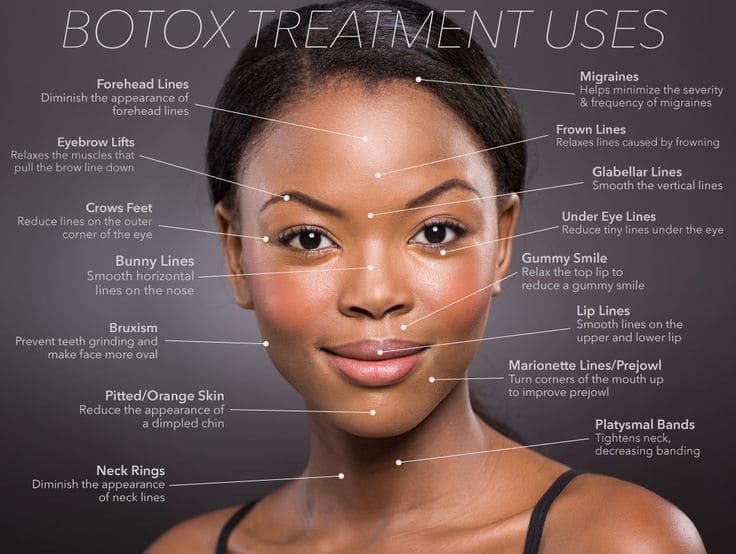 Common Botox treatment areas on the face