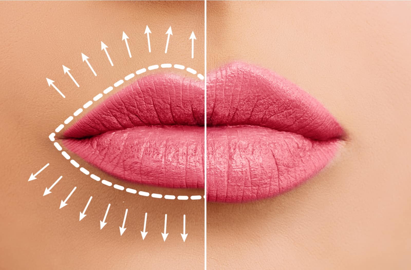 Lip Flip Procedure Diagram
