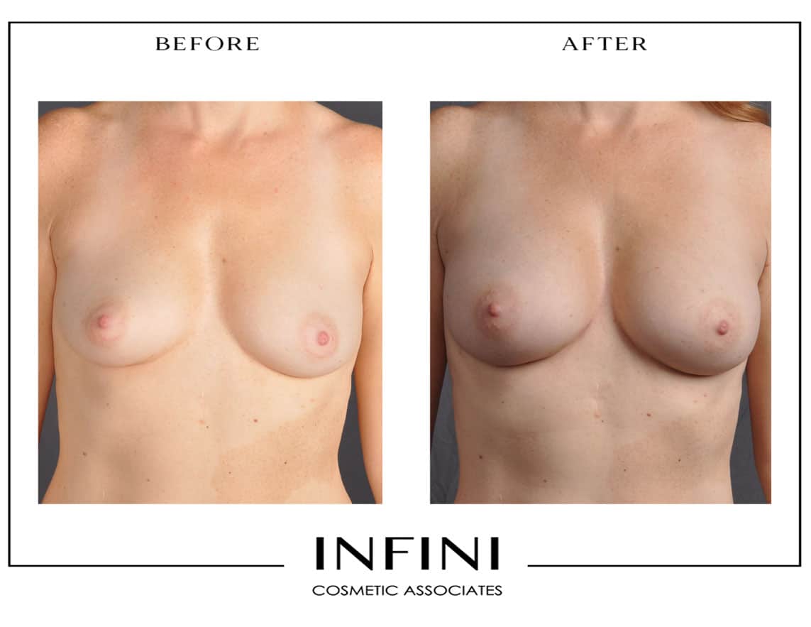 Fat Transfer Breast - Patient 4