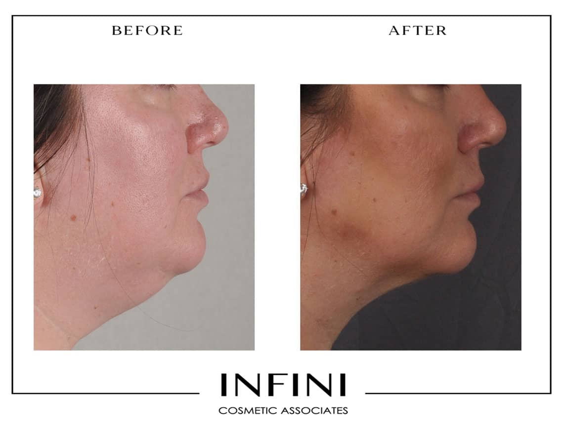 Scottsdale Liposuction - Patient 4