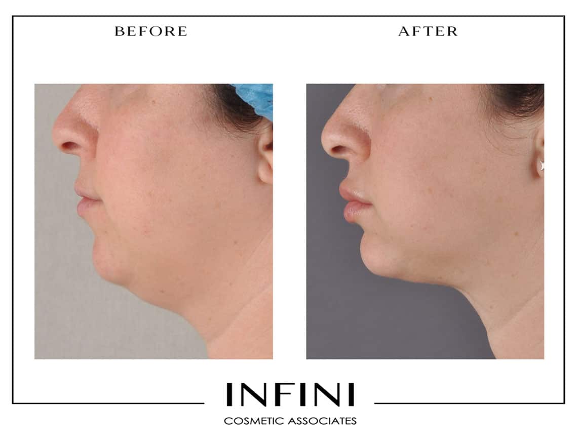 Scottsdale Liposuction - Patient 5