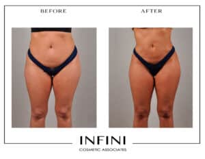 Liposucción de abdomen: tipos, proceso y elección del cirujano.