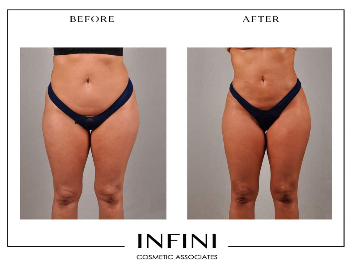 Scottsdale Liposuction - Patient 3