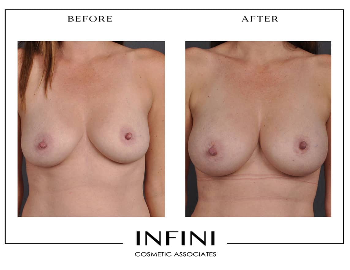 Fat Grafting to Breast - Patient 3