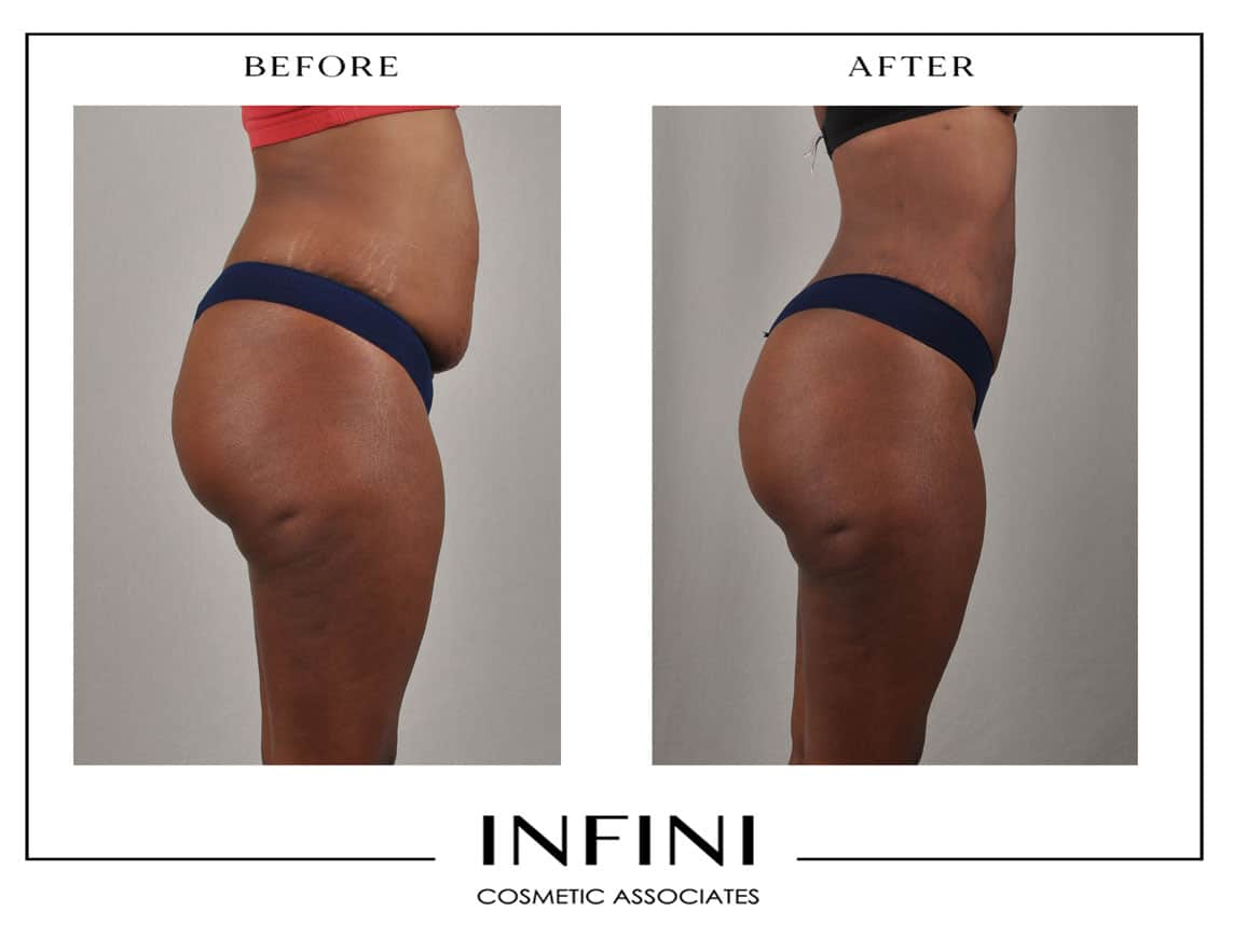 Scottsdale Liposuction - Patient 2