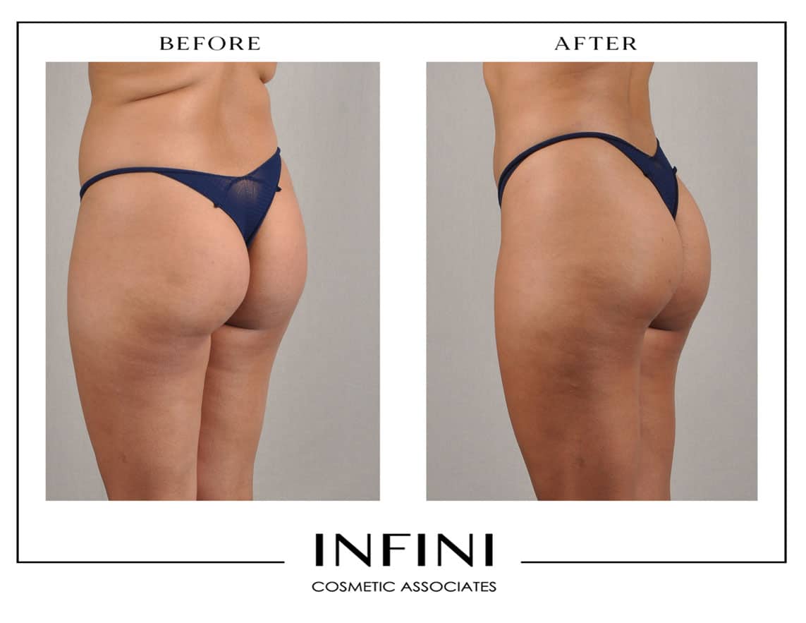 Scottsdale Liposuction - Patient 1