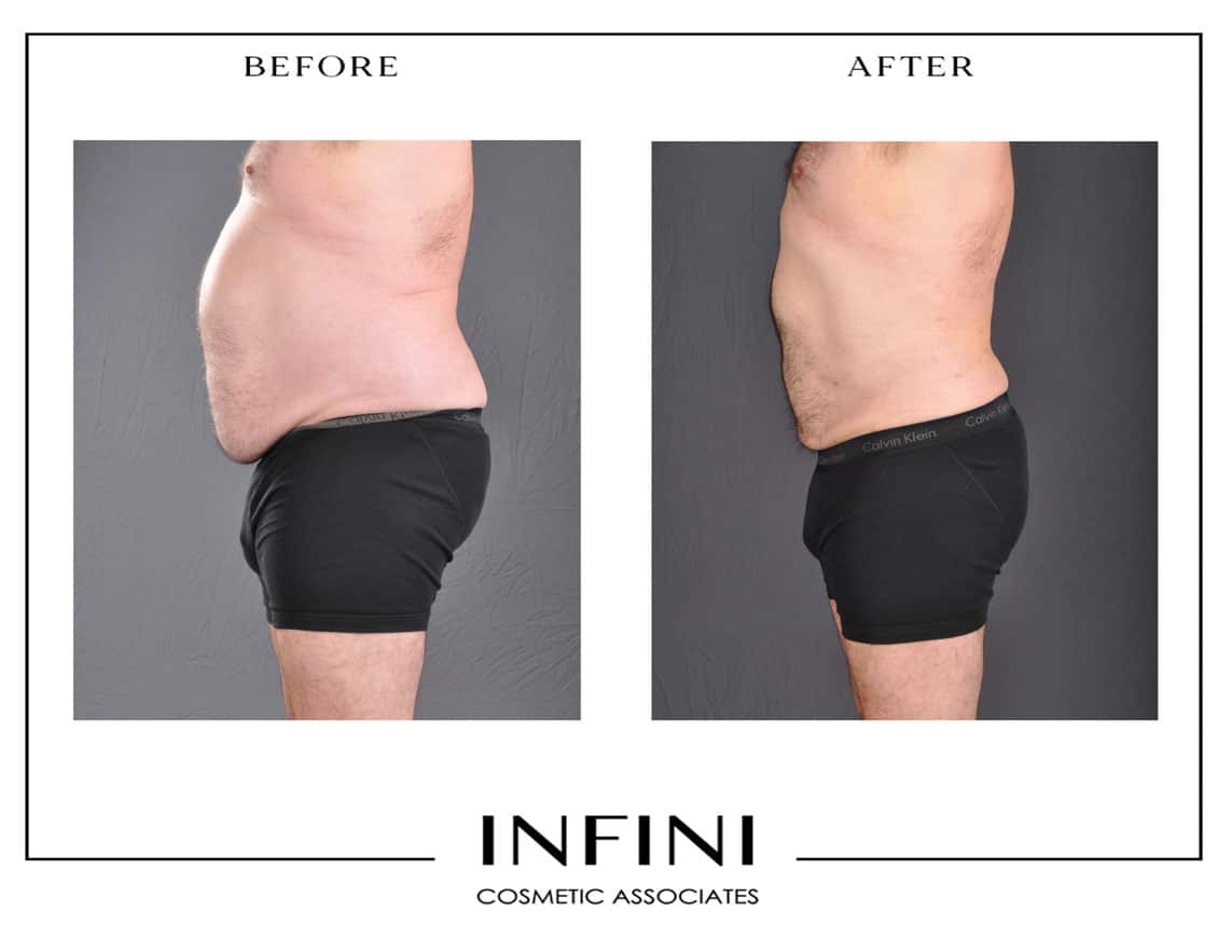 Male Abdomen Liposuction Before After