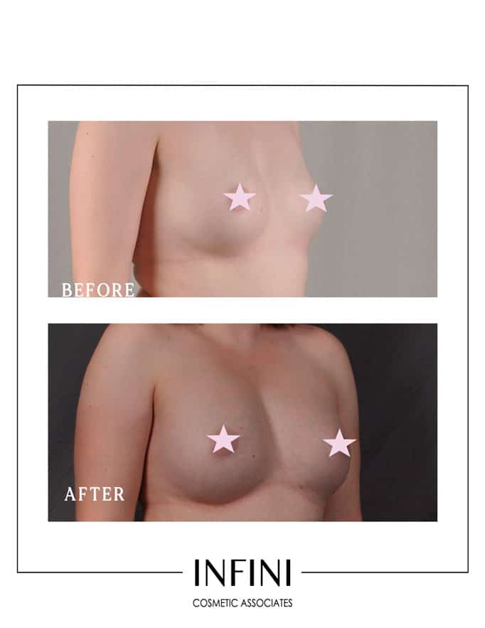 Natural Breast Augmentation - Patient 2