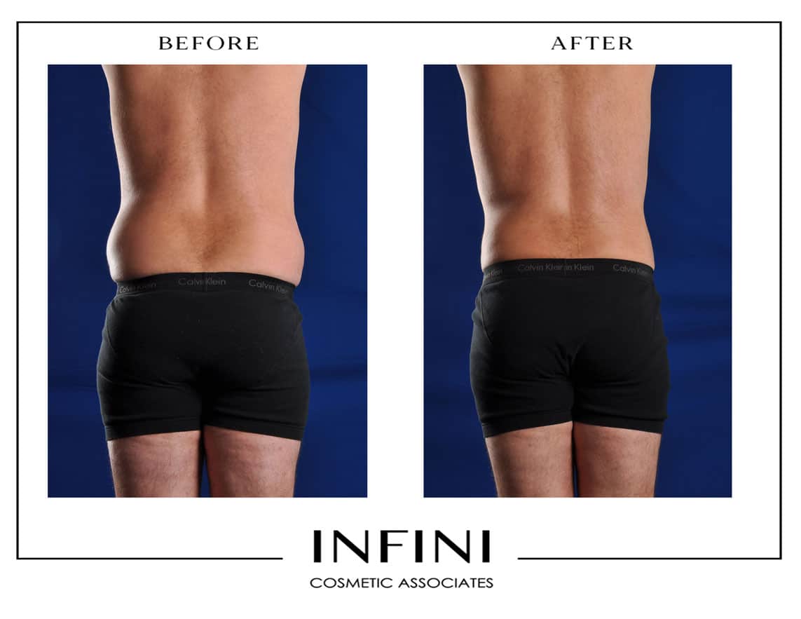 Male Flanks Liposuction Before After