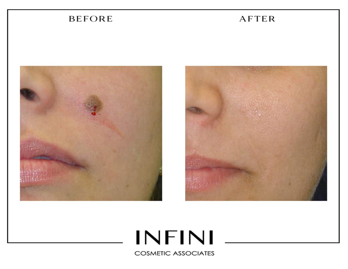 Mole Removal Before and After - Patient 1