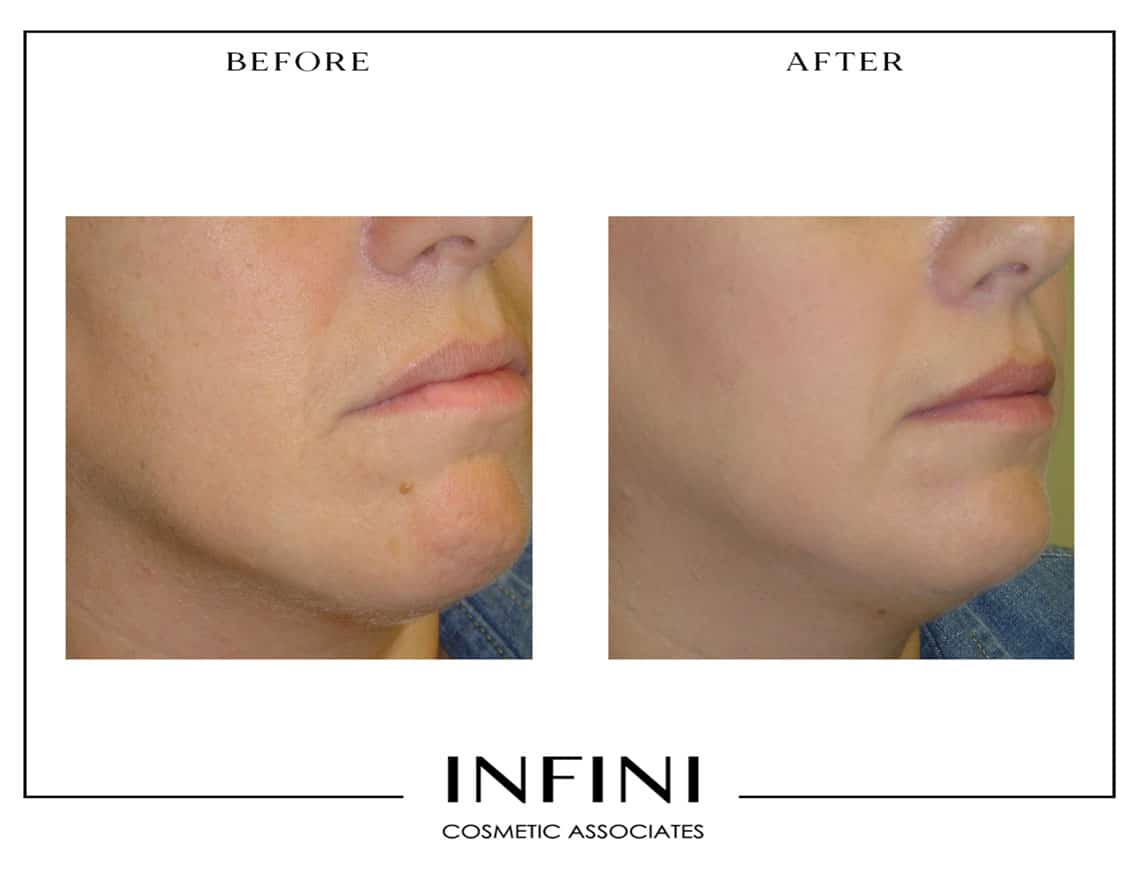 Skin Tag Removal Before and After - Patient 2