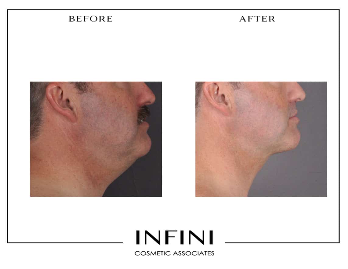 Male Chin Liposuction Before After