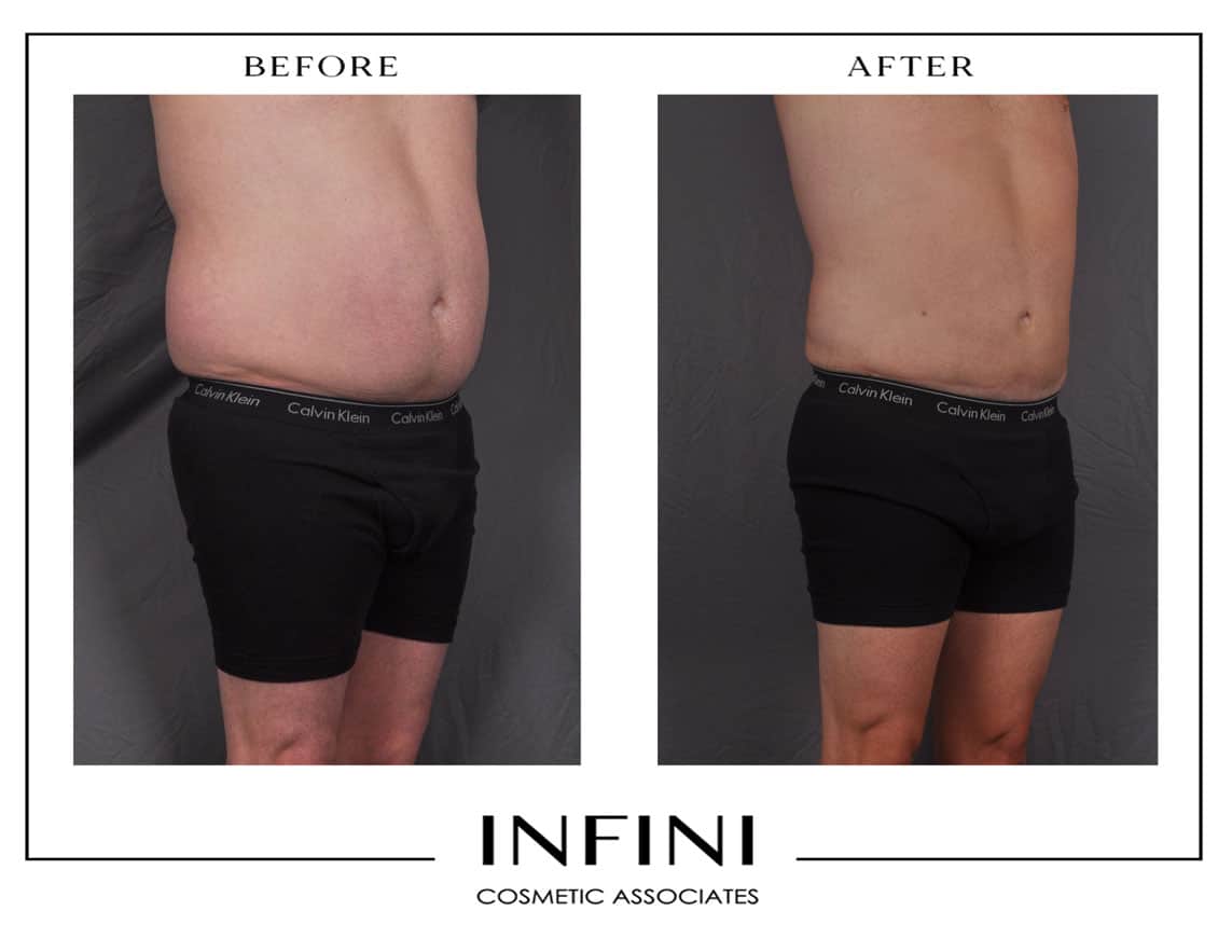 Male Waist Liposuction Before After
