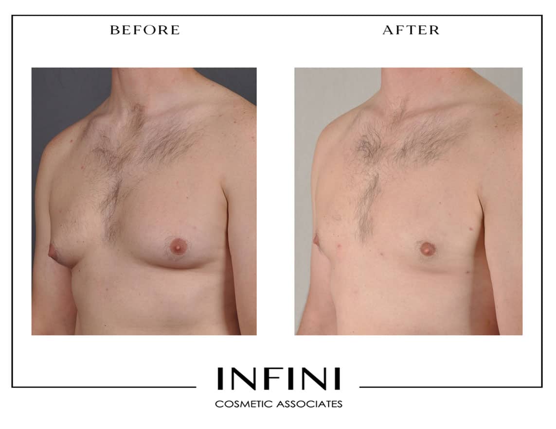 Male Chest Liposuction Before After