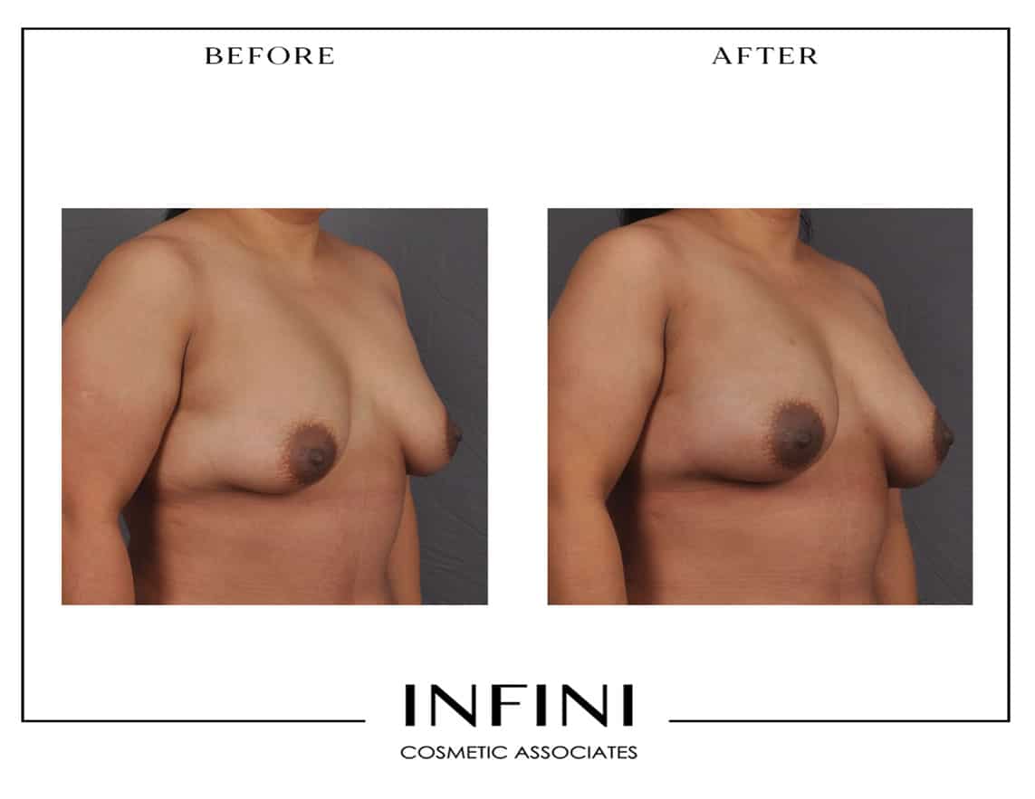 Fat Transfer to Breast - Patient 1 Before and After