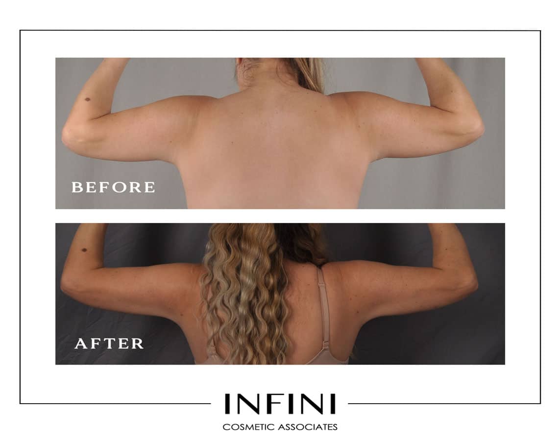 Scottsdale Liposuction - Patient 6