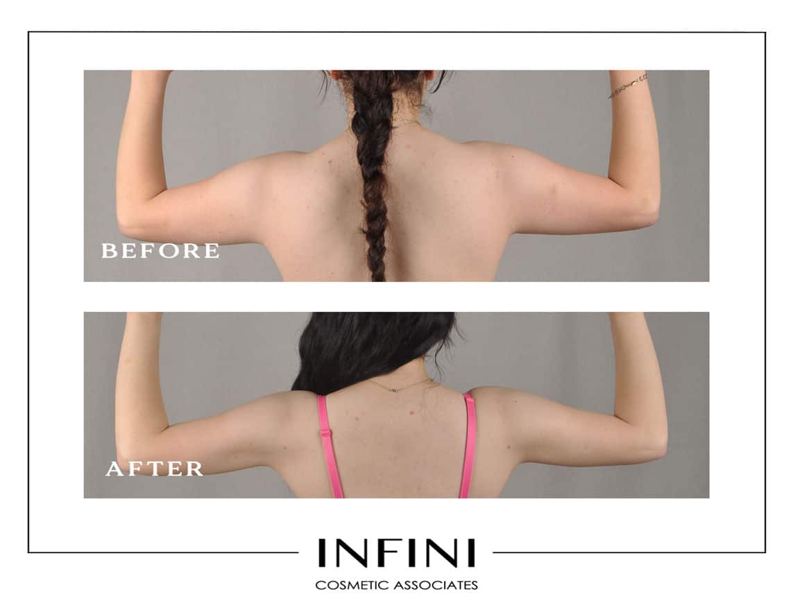 Scottsdale Liposuction - Patient 7