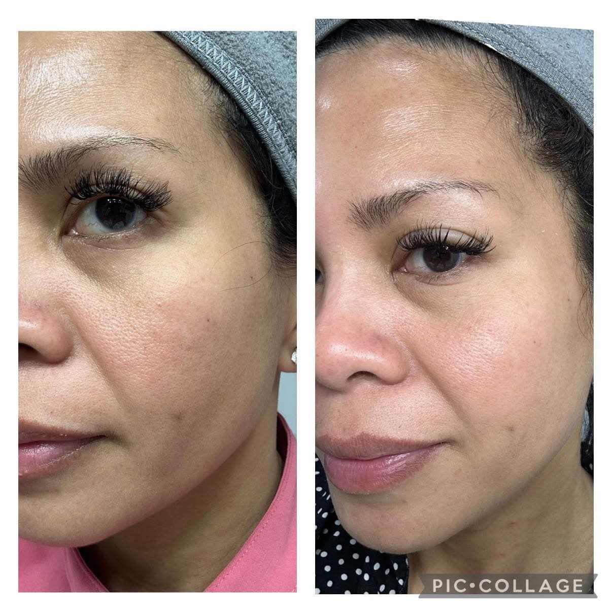 Female client eye area before and after showing reduced fine lines