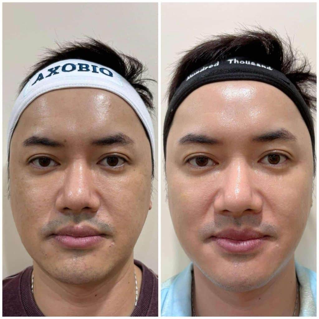 Male client before and after showing refined pores and even skin tone