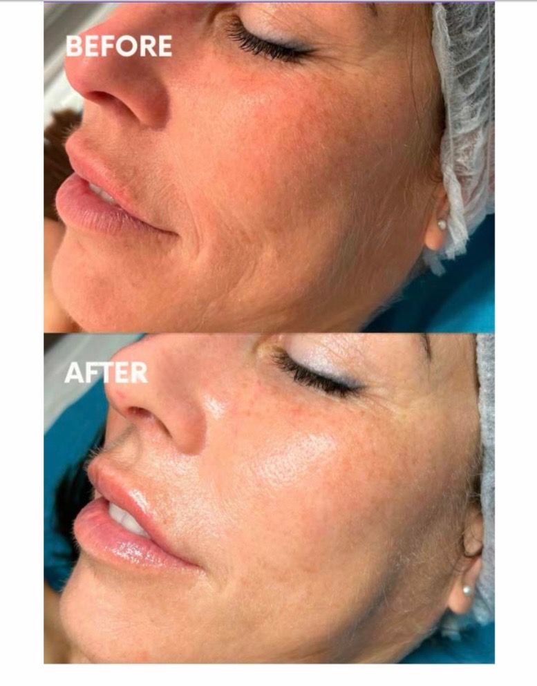 Before and after Salmon DNA therapy showing improved skin texture and hydration