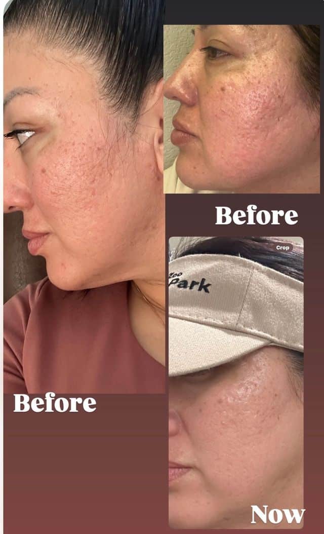 Multiple angle before and after comparison showing skin rejuvenation results
