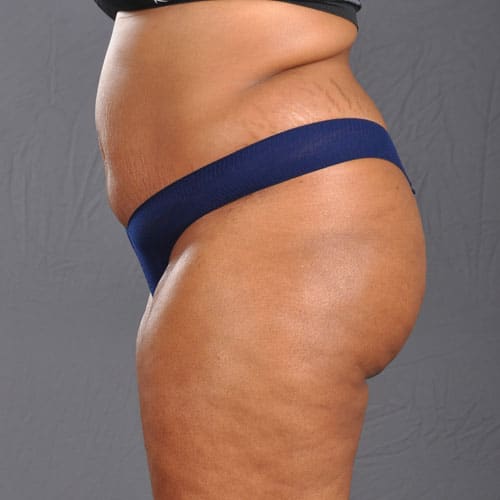 Infini Gentle Sculpt Before and After Result